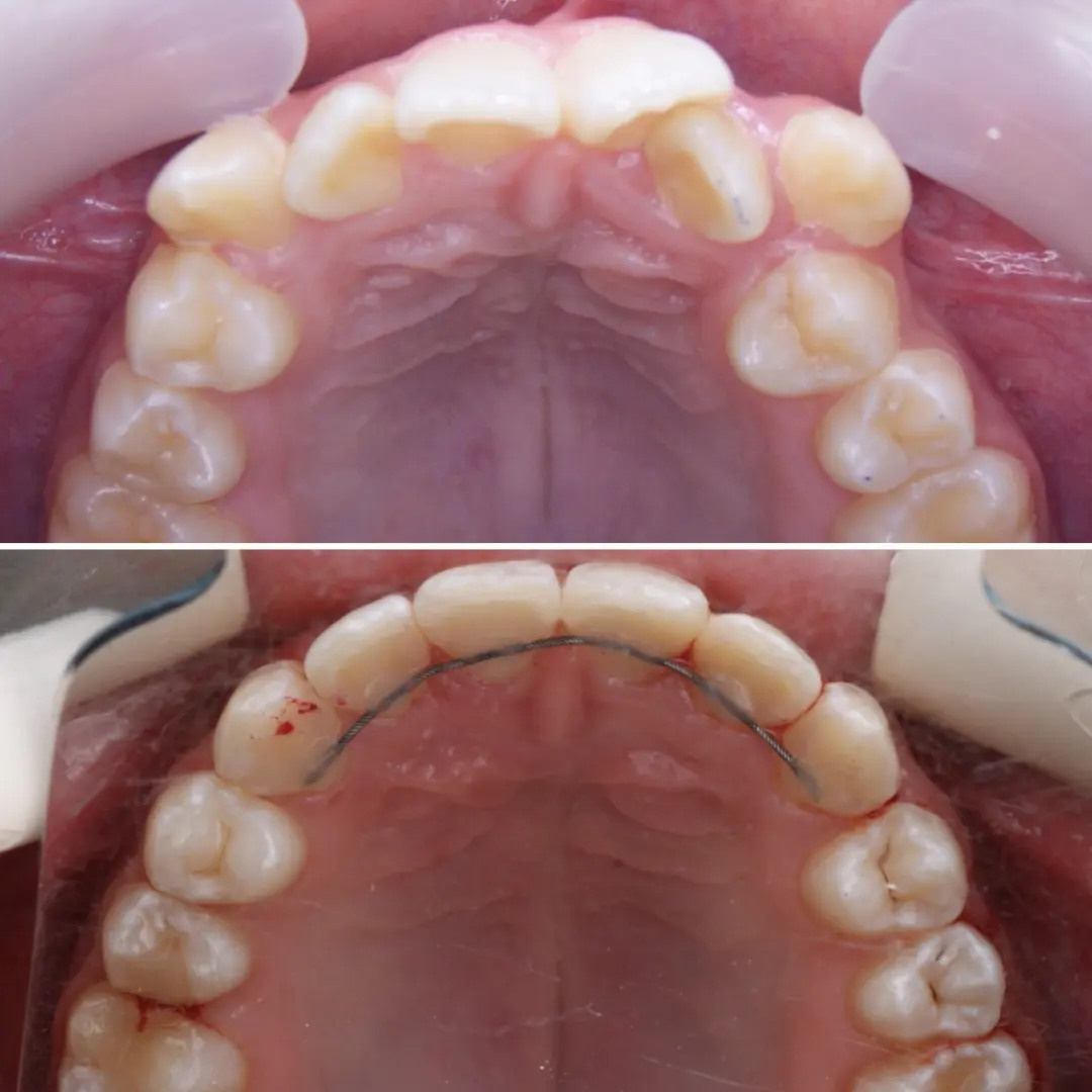 Блог врача. Стоматология «Ортодонт-Эстетик». Установка брекетов в Оренбурге, взрос