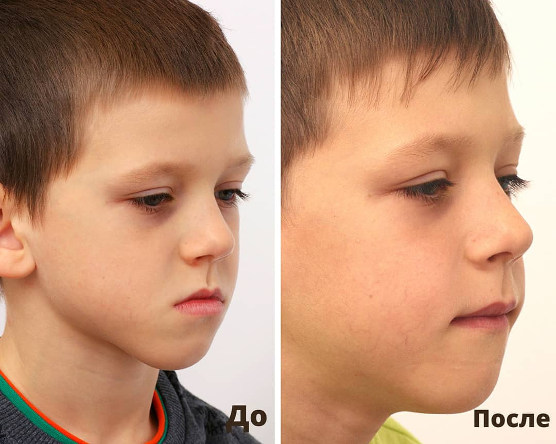 Блог врача. Стоматология «Ортодонт-Эстетик». Установка брекетов в Оренбурге, взрос