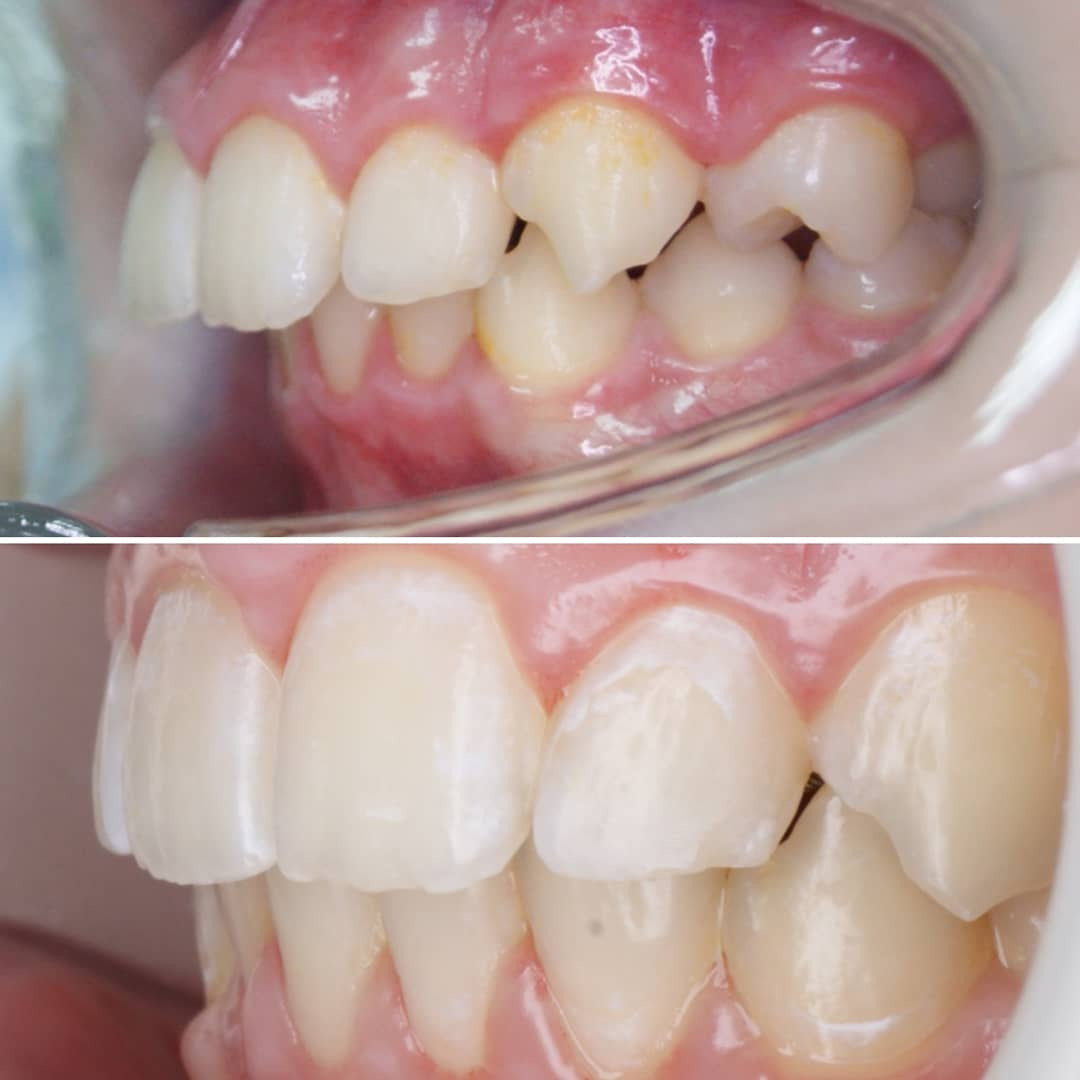 Блог врача. Стоматология «Ортодонт-Эстетик». Установка брекетов в Оренбурге, взрос