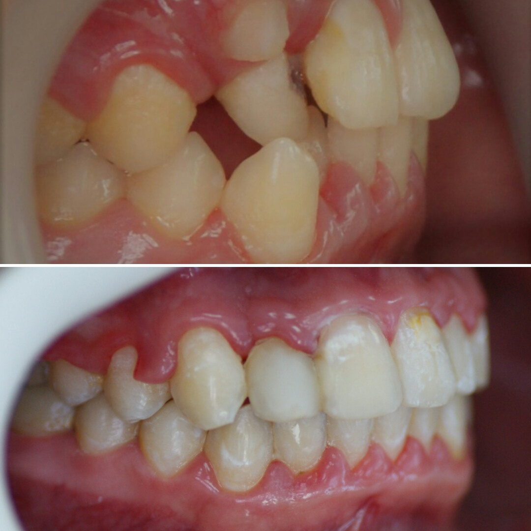 Блог врача. Стоматология «Ортодонт-Эстетик». Установка брекетов в Оренбурге, взрос