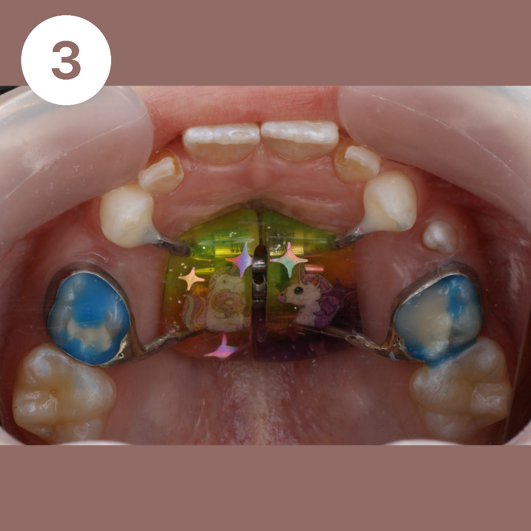 Блог врача. Стоматология «Ортодонт-Эстетик». Установка брекетов в Оренбурге, взрос