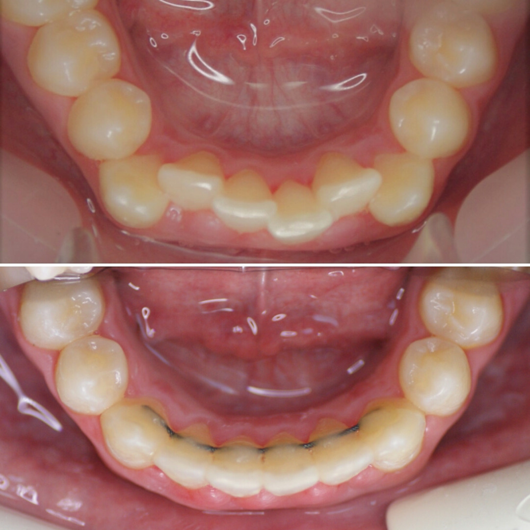 Блог врача. Стоматология «Ортодонт-Эстетик». Установка брекетов в Оренбурге, взрос