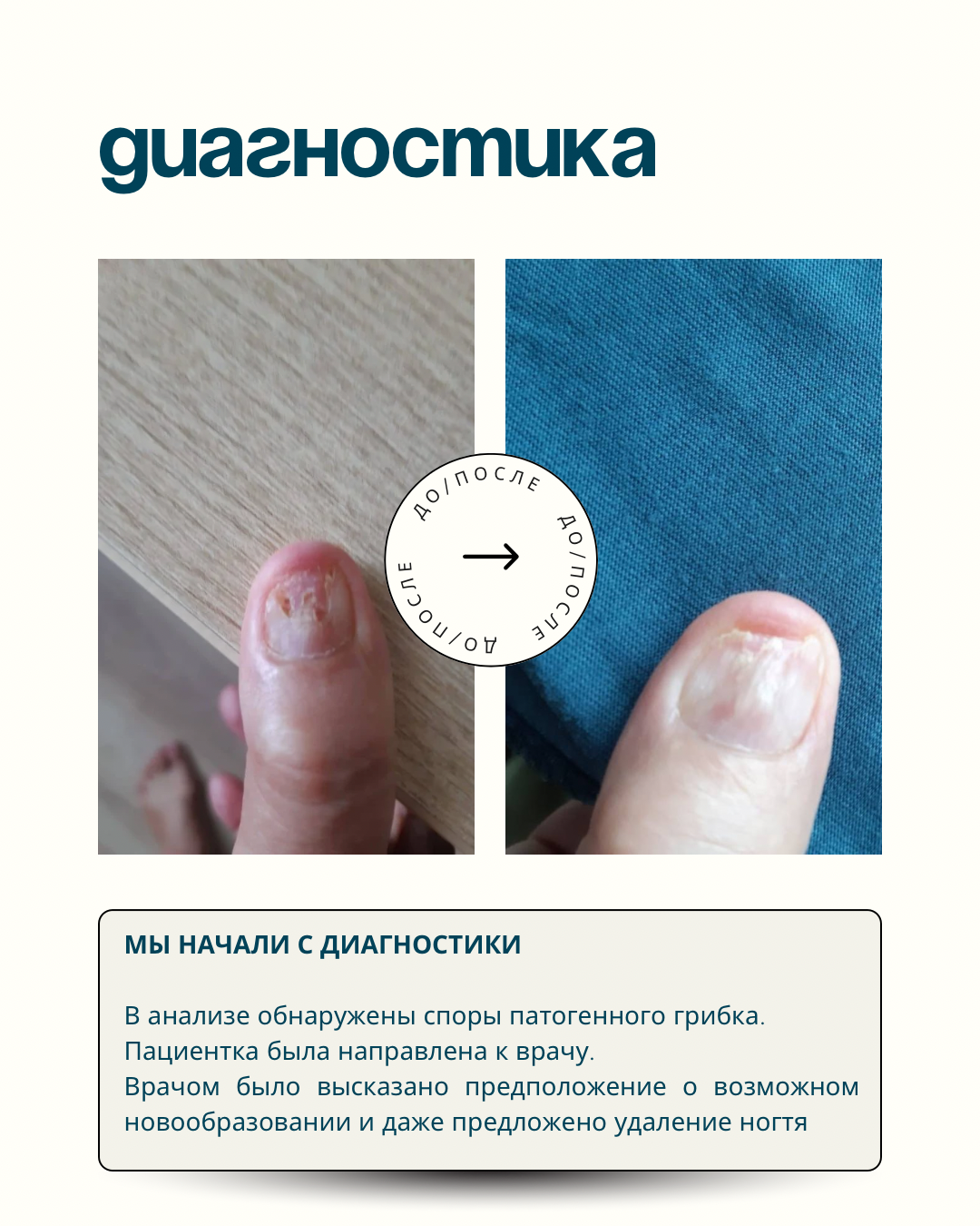 Грибок ногтя на руке. Подолог г. Хабаровск — центр здоровой стопы «FOOTTIME»