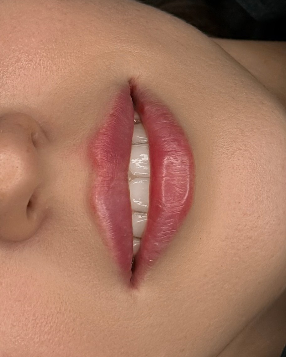 Увеличение губ филлерами в Москве — цена от 18 000 ₽, фото до и после | Студия SYMMETRY