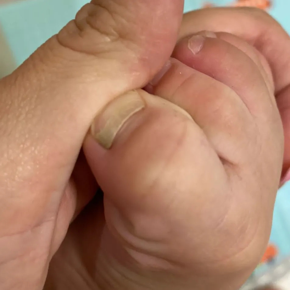 Онихомадезис у малыша. Подолог г. Хабаровск — центр здоровой стопы «FOOTTIME»