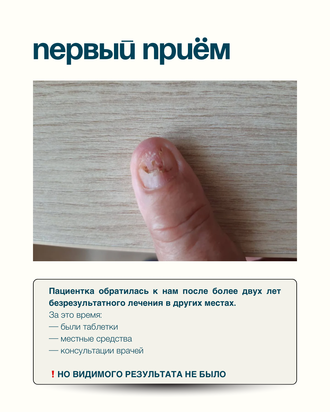 Грибок ногтя на руке. Подолог г. Хабаровск — центр здоровой стопы «FOOTTIME»