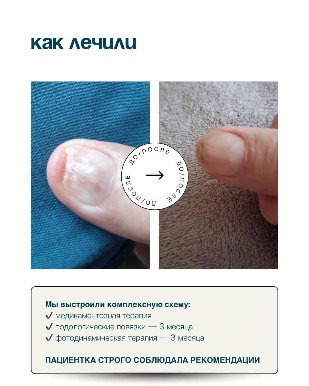 Грибок ногтя на руке. Подолог г. Хабаровск — центр здоровой стопы «FOOTTIME»