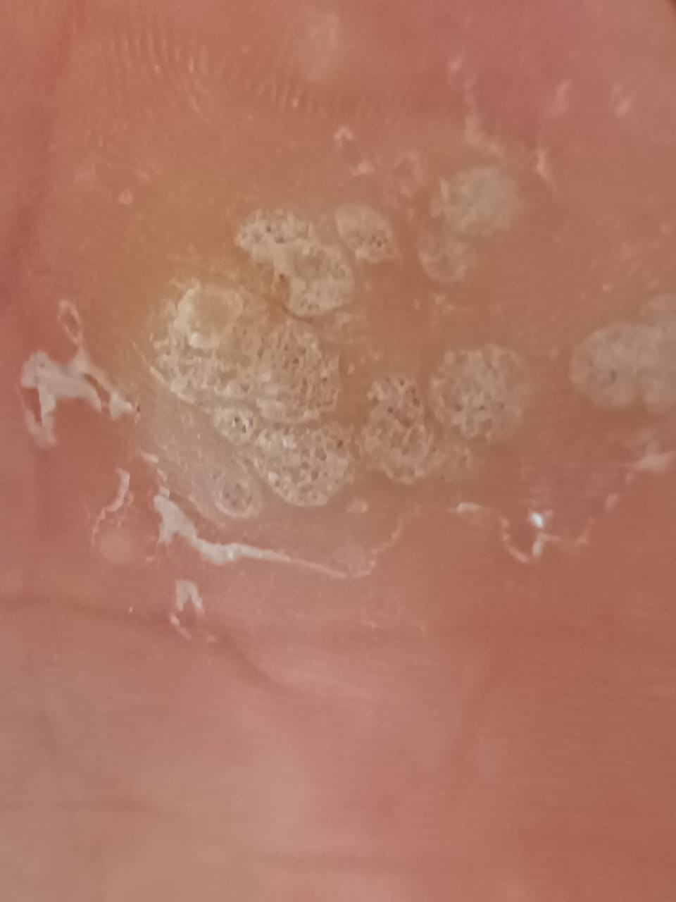 Множественные бородавки. Подолог г. Хабаровск — центр здоровой стопы «FOOTTIME»