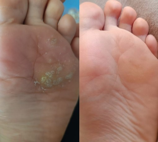 Множественные бородавки. Подолог г. Хабаровск — центр здоровой стопы «FOOTTIME»