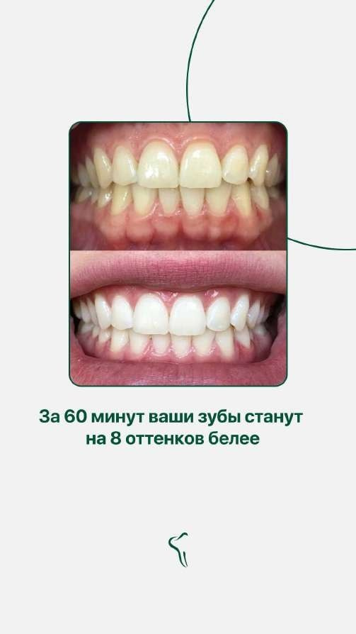 Результат до и после в Albentes: на 8 оттенков белее за 60 минут — рекламный креатив