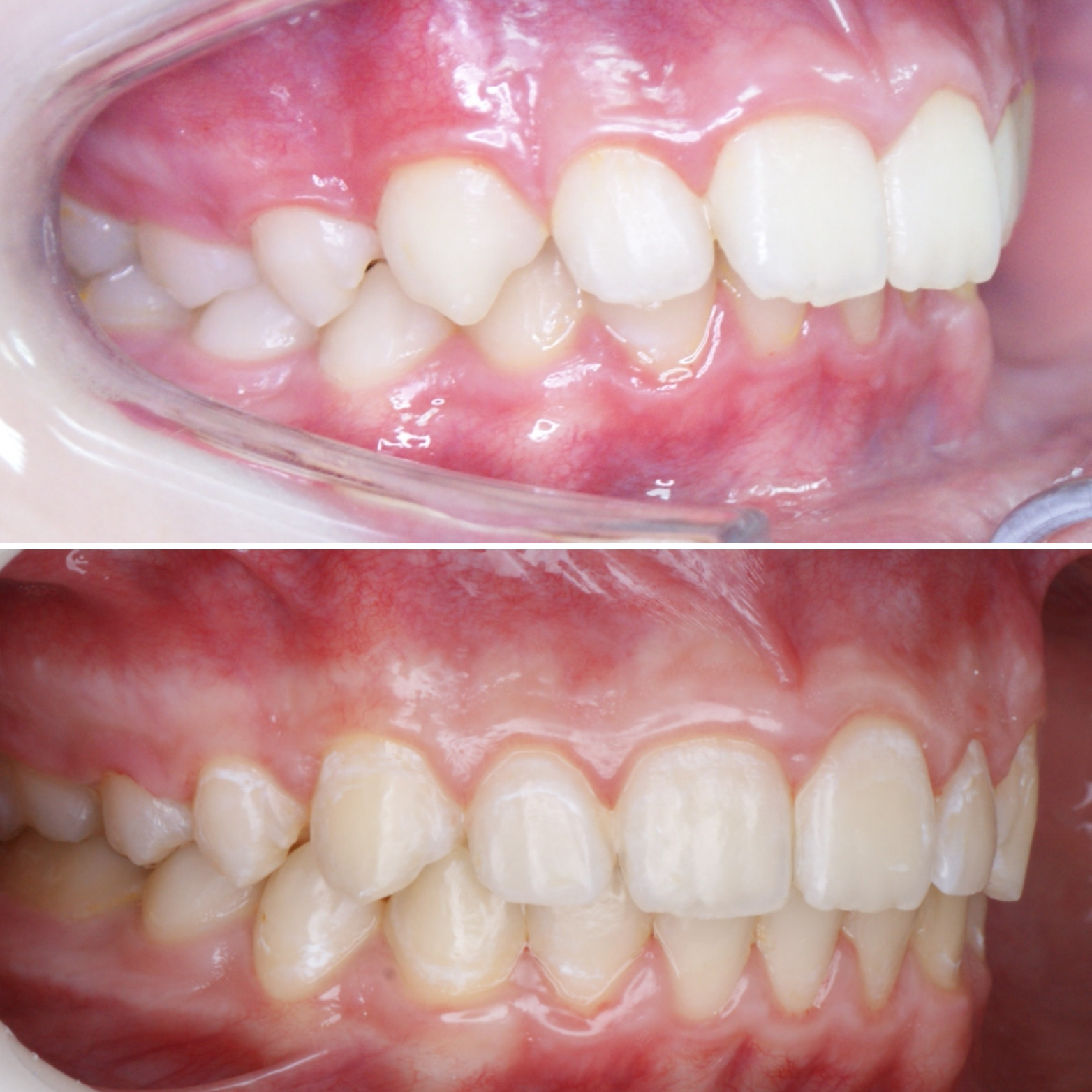 Блог врача. Стоматология «Ортодонт-Эстетик». Установка брекетов в Оренбурге, взрос