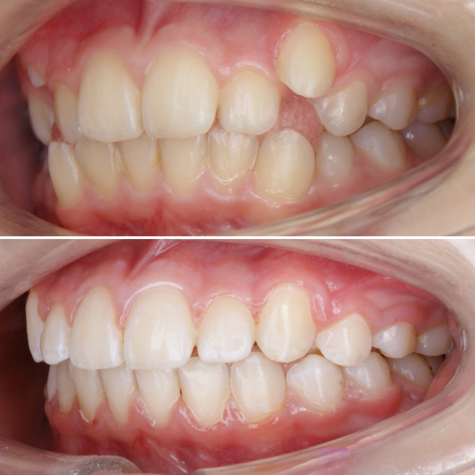 Блог врача. Стоматология «Ортодонт-Эстетик». Установка брекетов в Оренбурге, взрос