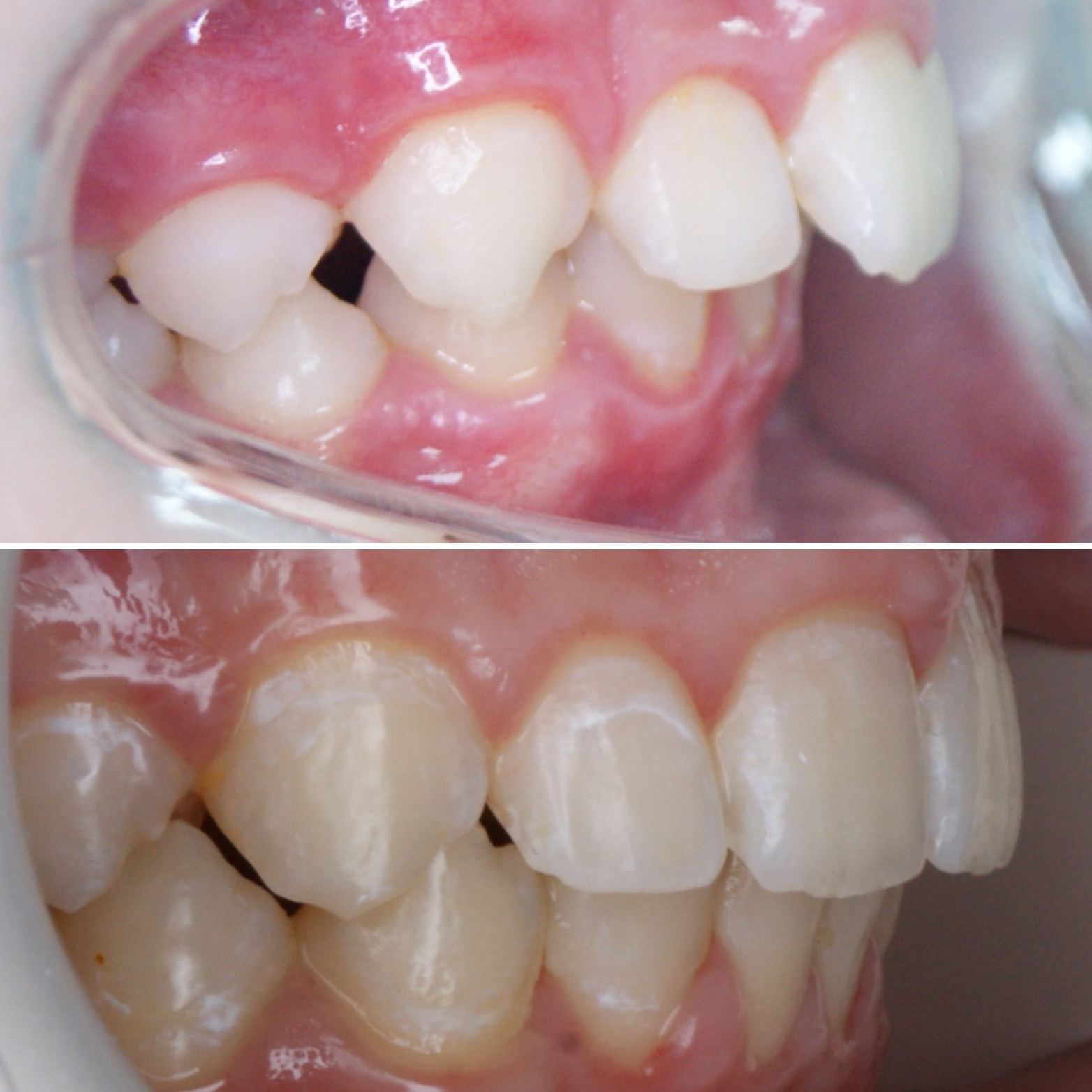 Блог врача. Стоматология «Ортодонт-Эстетик». Установка брекетов в Оренбурге, взрос