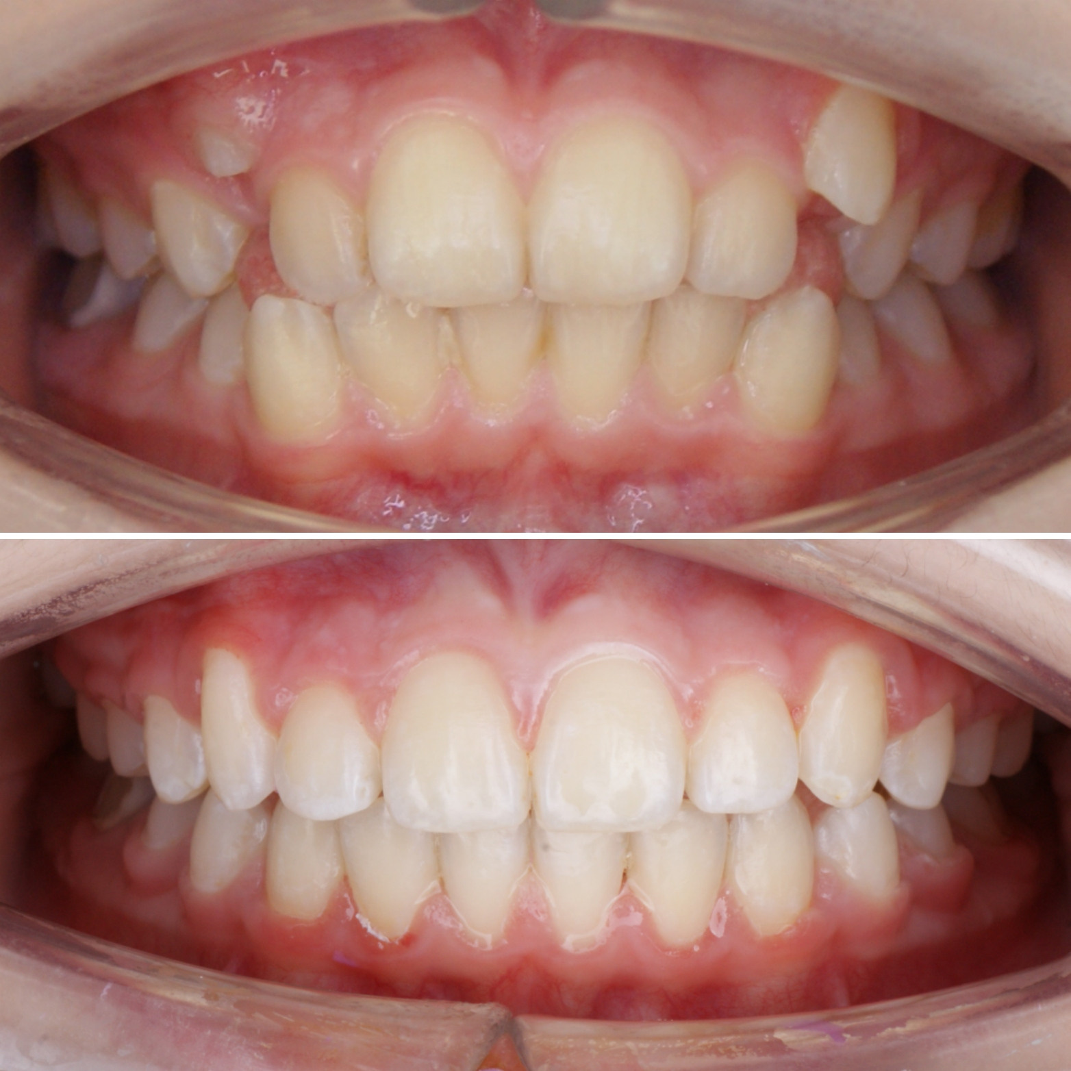 Блог врача. Стоматология «Ортодонт-Эстетик». Установка брекетов в Оренбурге, взрос