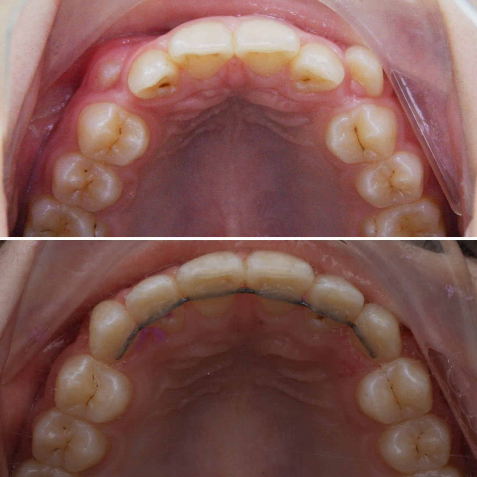 Блог врача. Стоматология «Ортодонт-Эстетик». Установка брекетов в Оренбурге, взрос