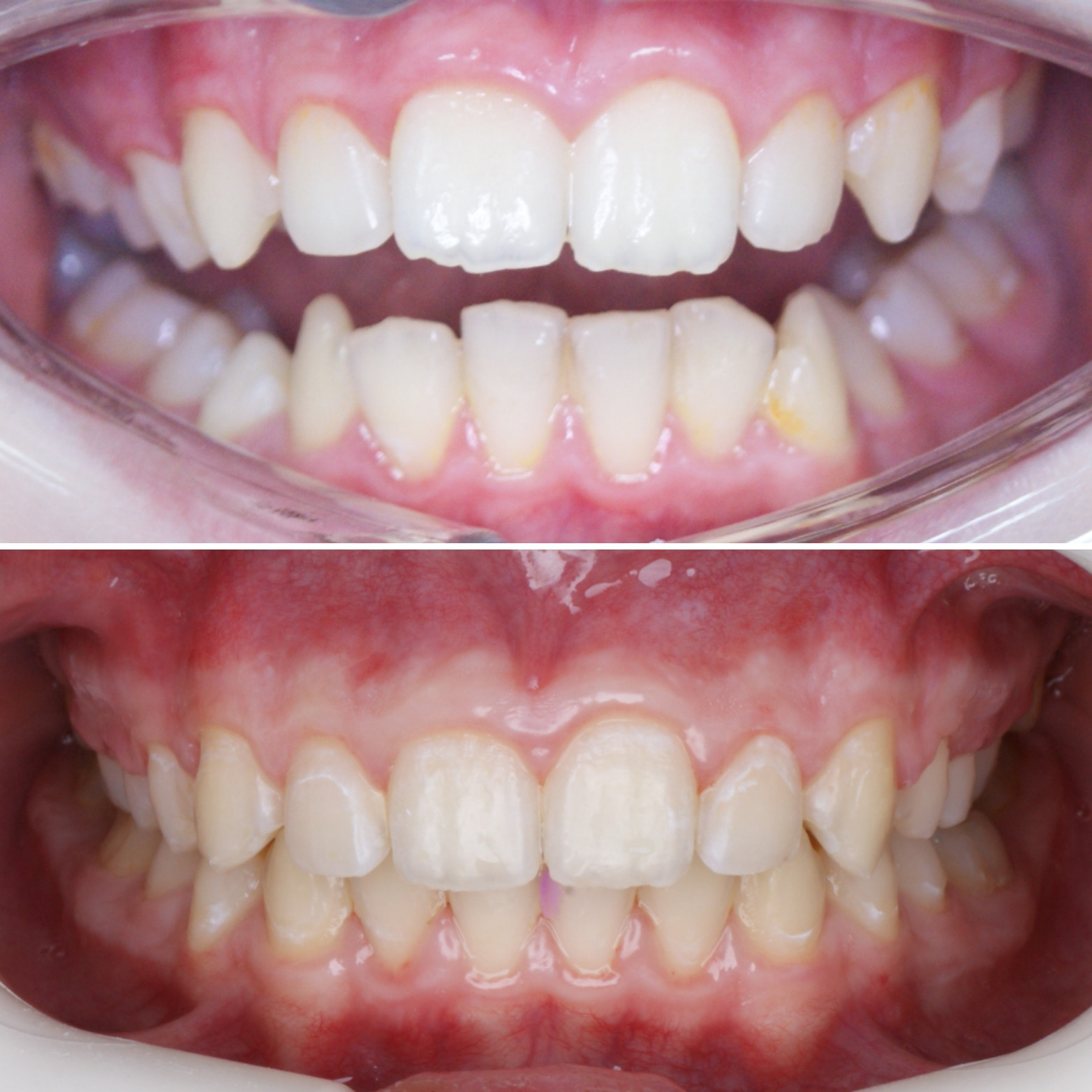 Блог врача. Стоматология «Ортодонт-Эстетик». Установка брекетов в Оренбурге, взрос