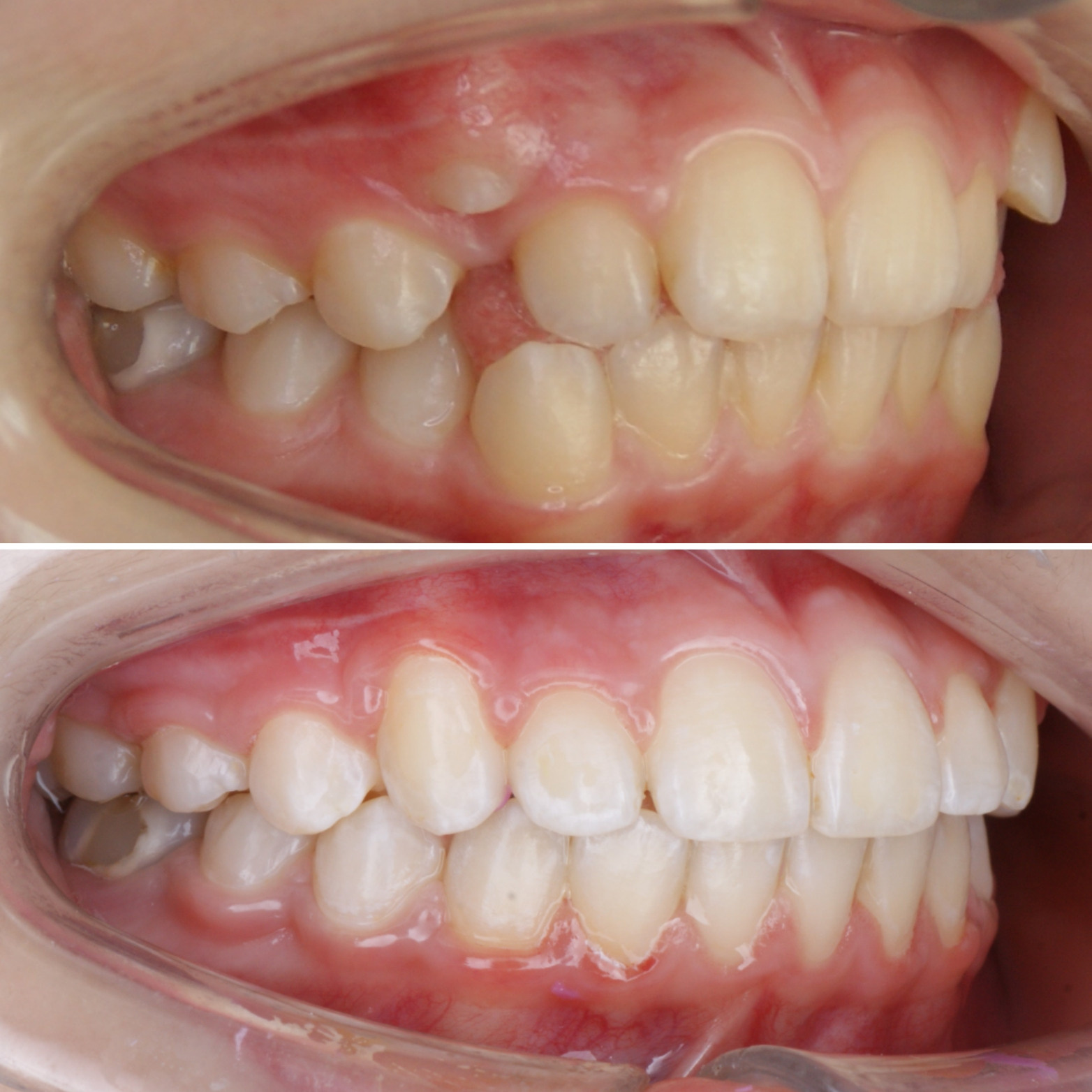 Блог врача. Стоматология «Ортодонт-Эстетик». Установка брекетов в Оренбурге, взрос