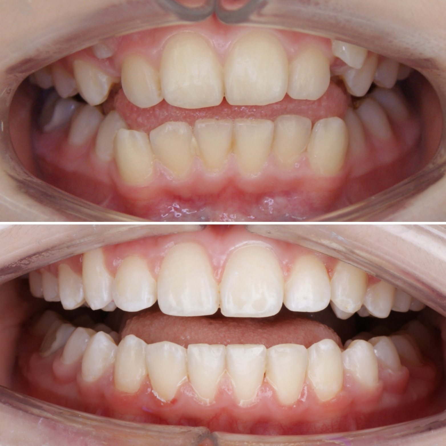 Блог врача. Стоматология «Ортодонт-Эстетик». Установка брекетов в Оренбурге, взрос