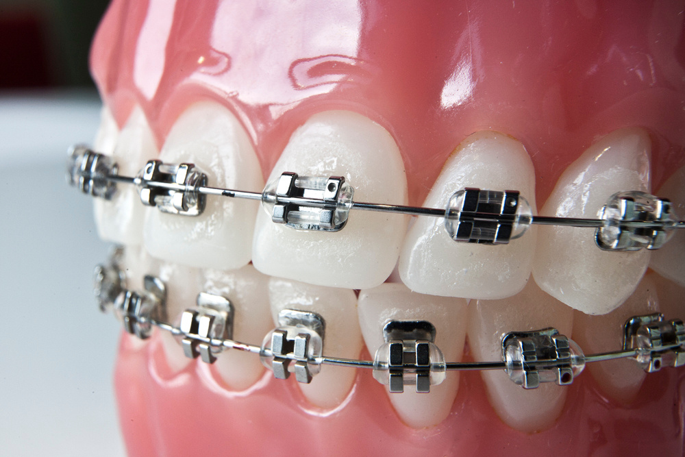 Обычные классические брекеты. Стоматология «Ортодонт-Эстетик». Установка брекетов в Оренбурге, взрос