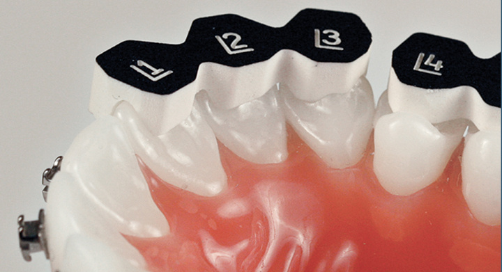 Индивидуальные брекеты, изготовленные по цифровым технологиям. Стоматология «Ортодонт-Эстетик». Установка брекетов в Оренбурге, взрос