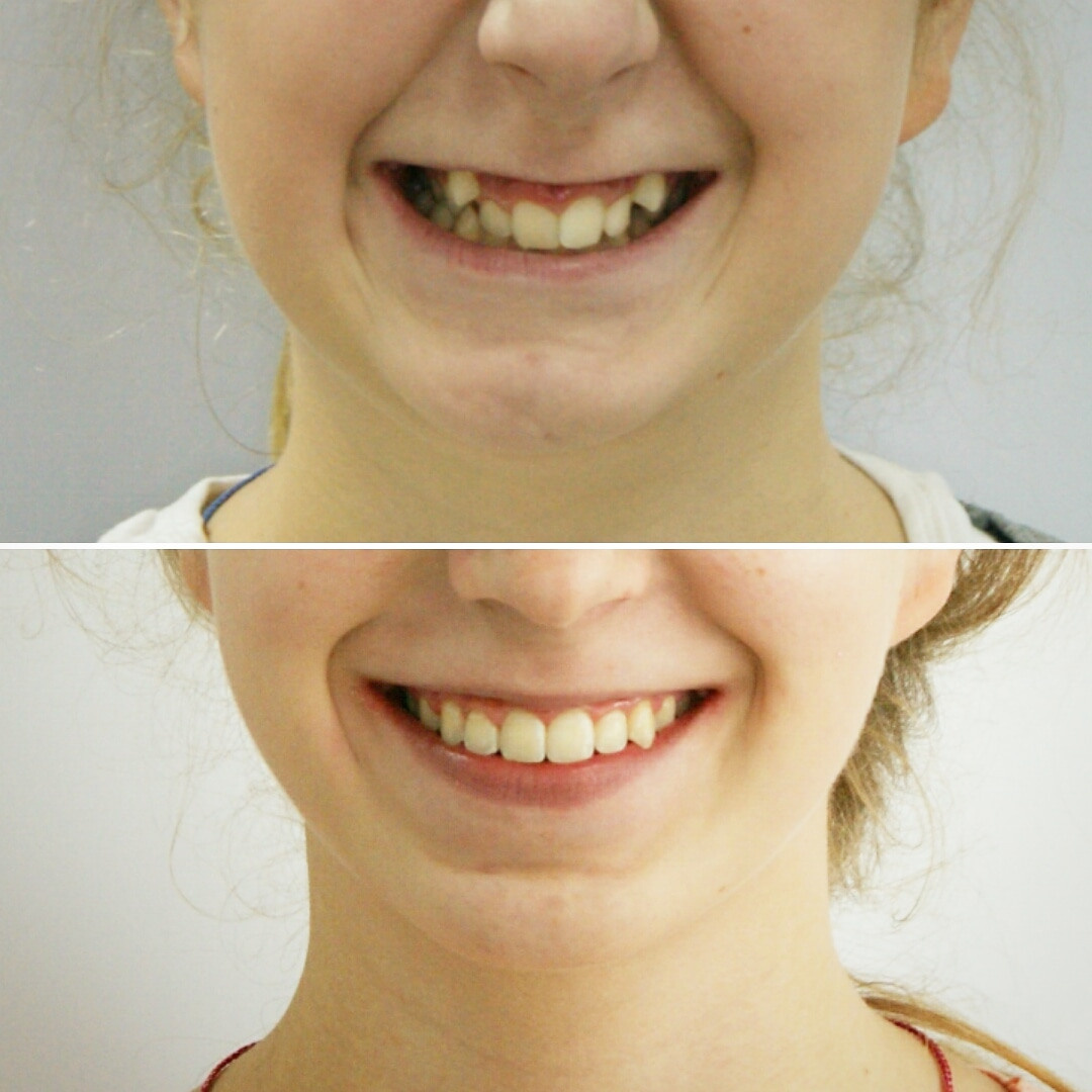 Блог врача. Стоматология «Ортодонт-Эстетик». Установка брекетов в Оренбурге, взрос