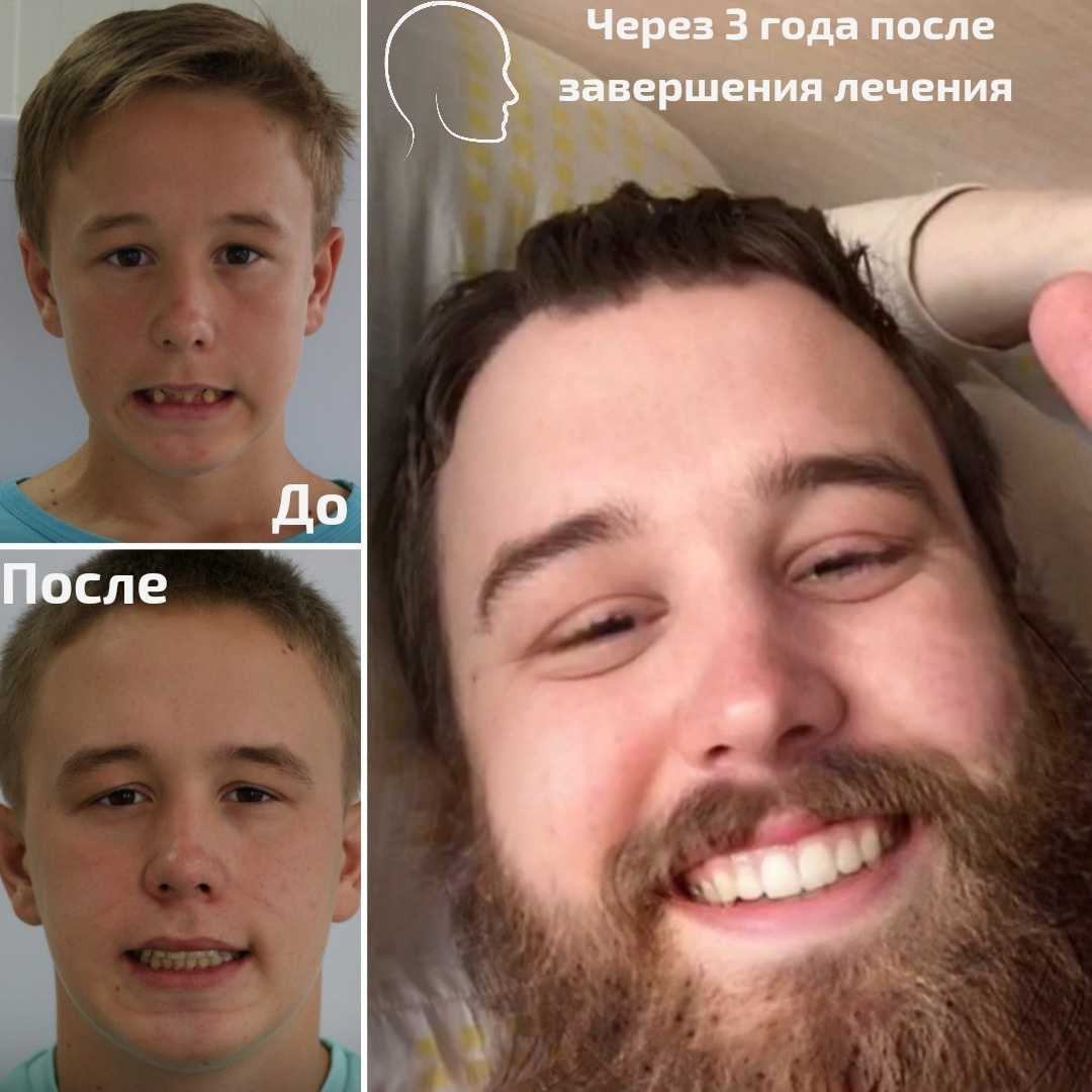 Блог врача. Стоматология «Ортодонт-Эстетик». Установка брекетов в Оренбурге, взрос