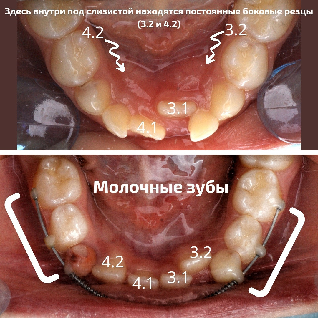 Блог врача. Стоматология «Ортодонт-Эстетик». Установка брекетов в Оренбурге, взрос