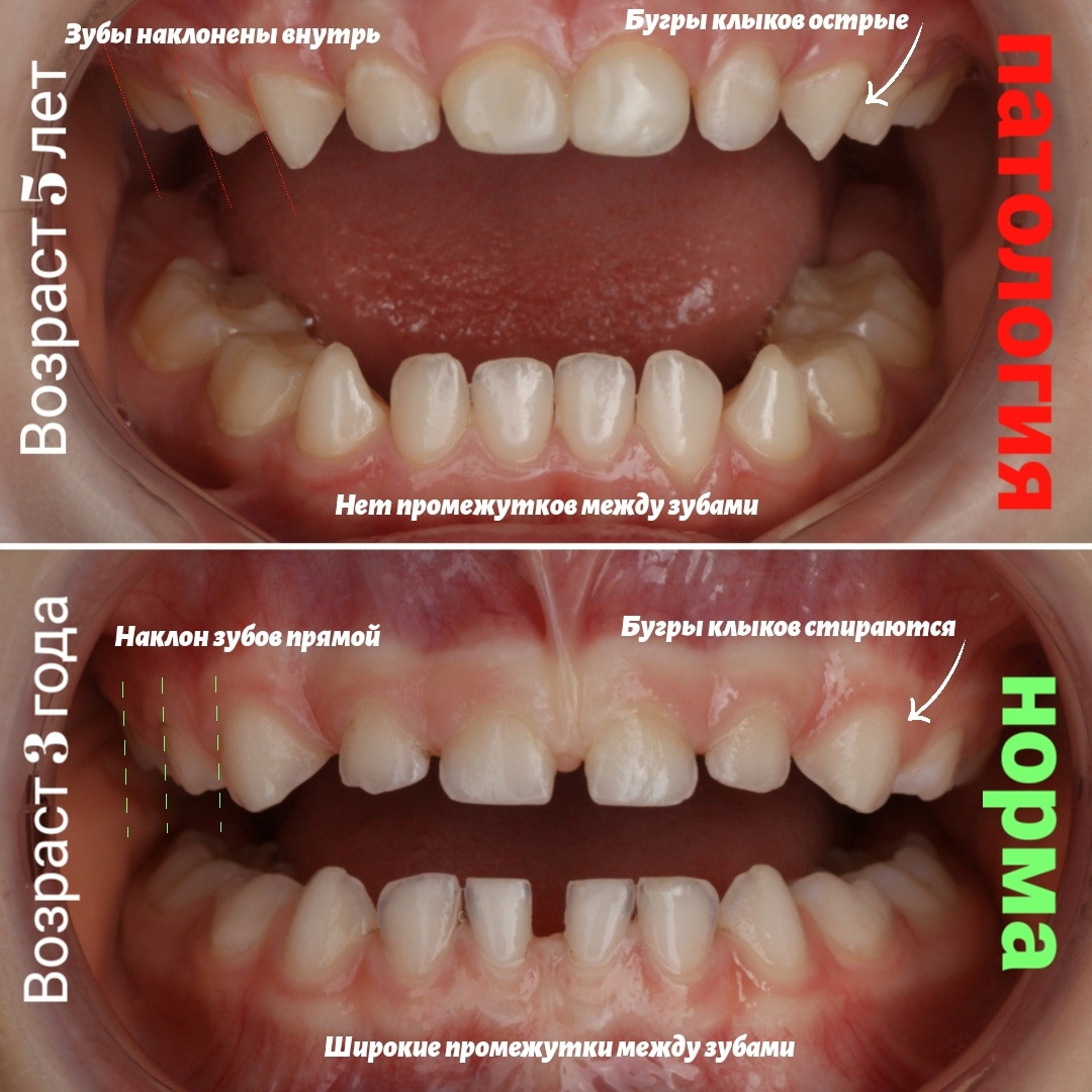 Блог врача. Стоматология «Ортодонт-Эстетик». Установка брекетов в Оренбурге, взрос