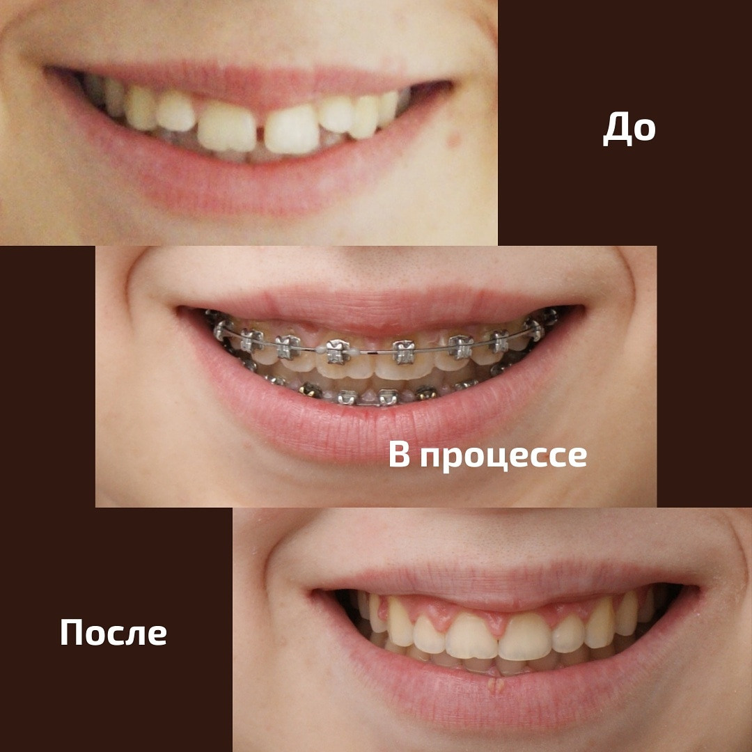 Блог врача. Стоматология «Ортодонт-Эстетик». Установка брекетов в Оренбурге, взрос