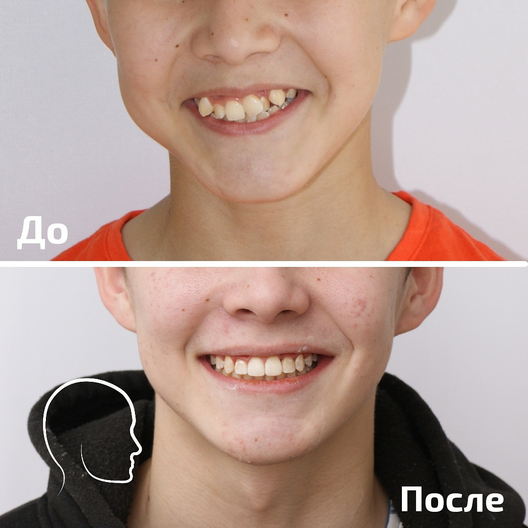 Блог врача. Стоматология «Ортодонт-Эстетик». Установка брекетов в Оренбурге, взрос