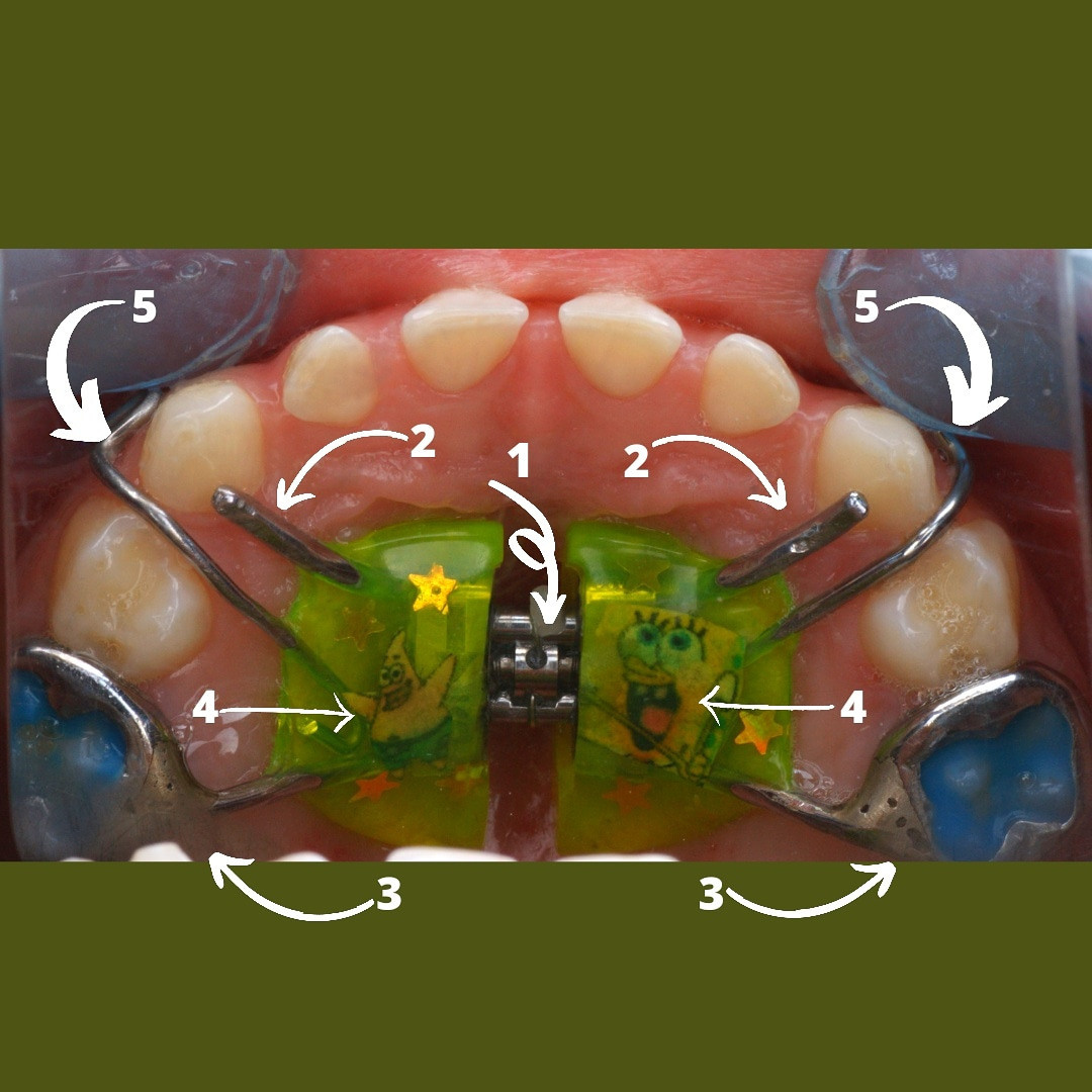 Блог врача. Стоматология «Ортодонт-Эстетик». Установка брекетов в Оренбурге, взрос