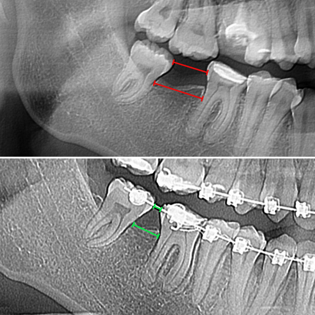Блог врача. Стоматология «Ортодонт-Эстетик». Установка брекетов в Оренбурге, взрос