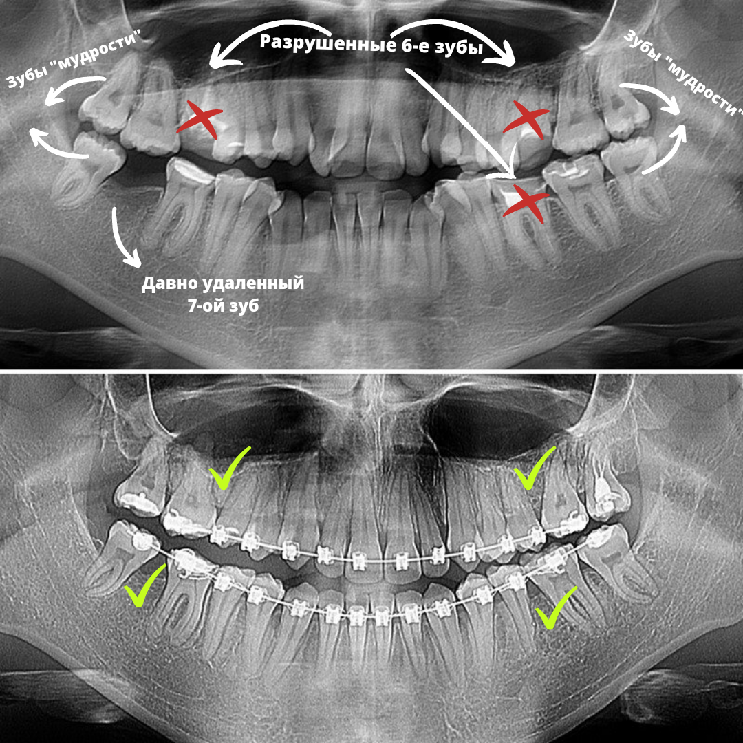 Блог врача. Стоматология «Ортодонт-Эстетик». Установка брекетов в Оренбурге, взрос
