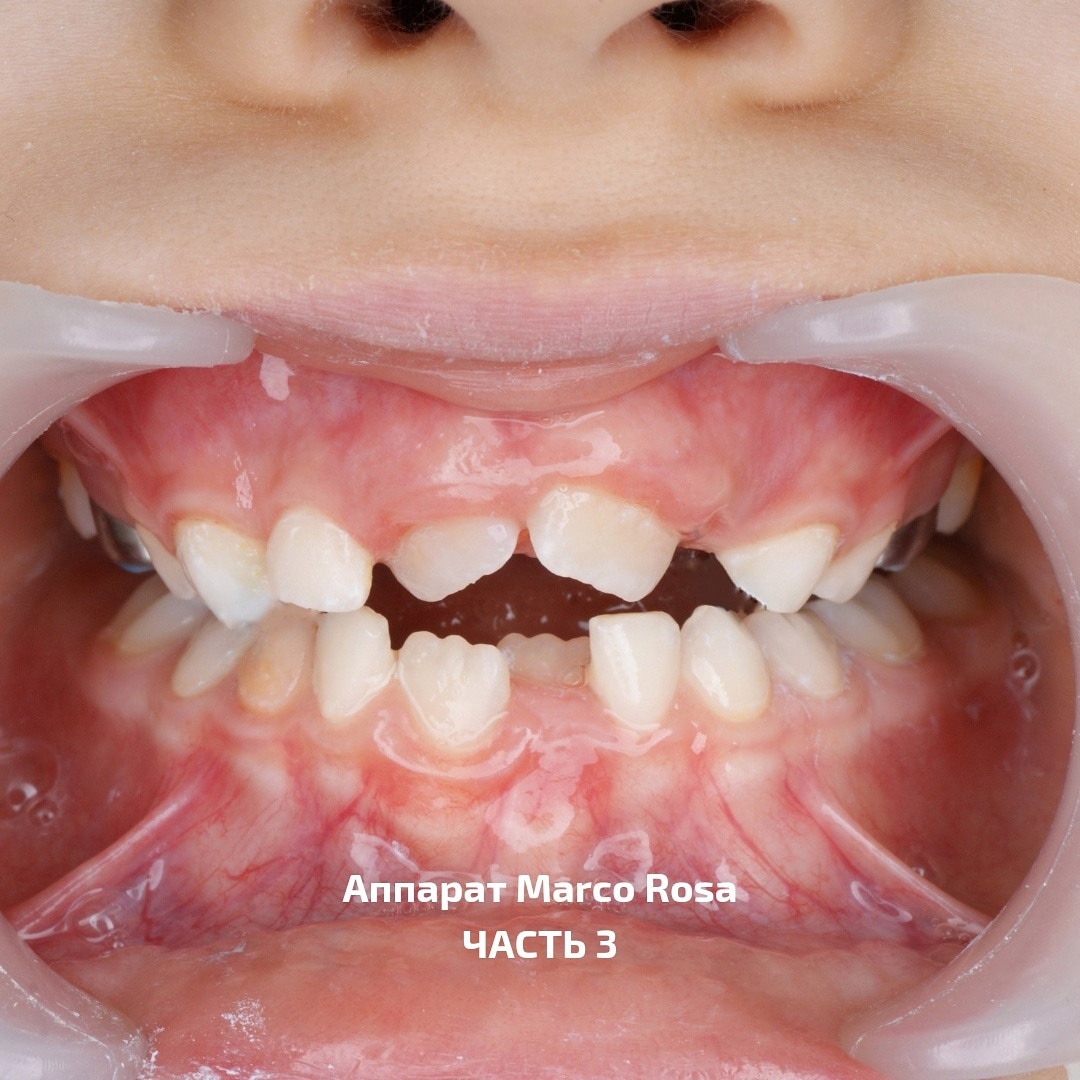 Блог врача. Стоматология «Ортодонт-Эстетик». Установка брекетов в Оренбурге, взрос