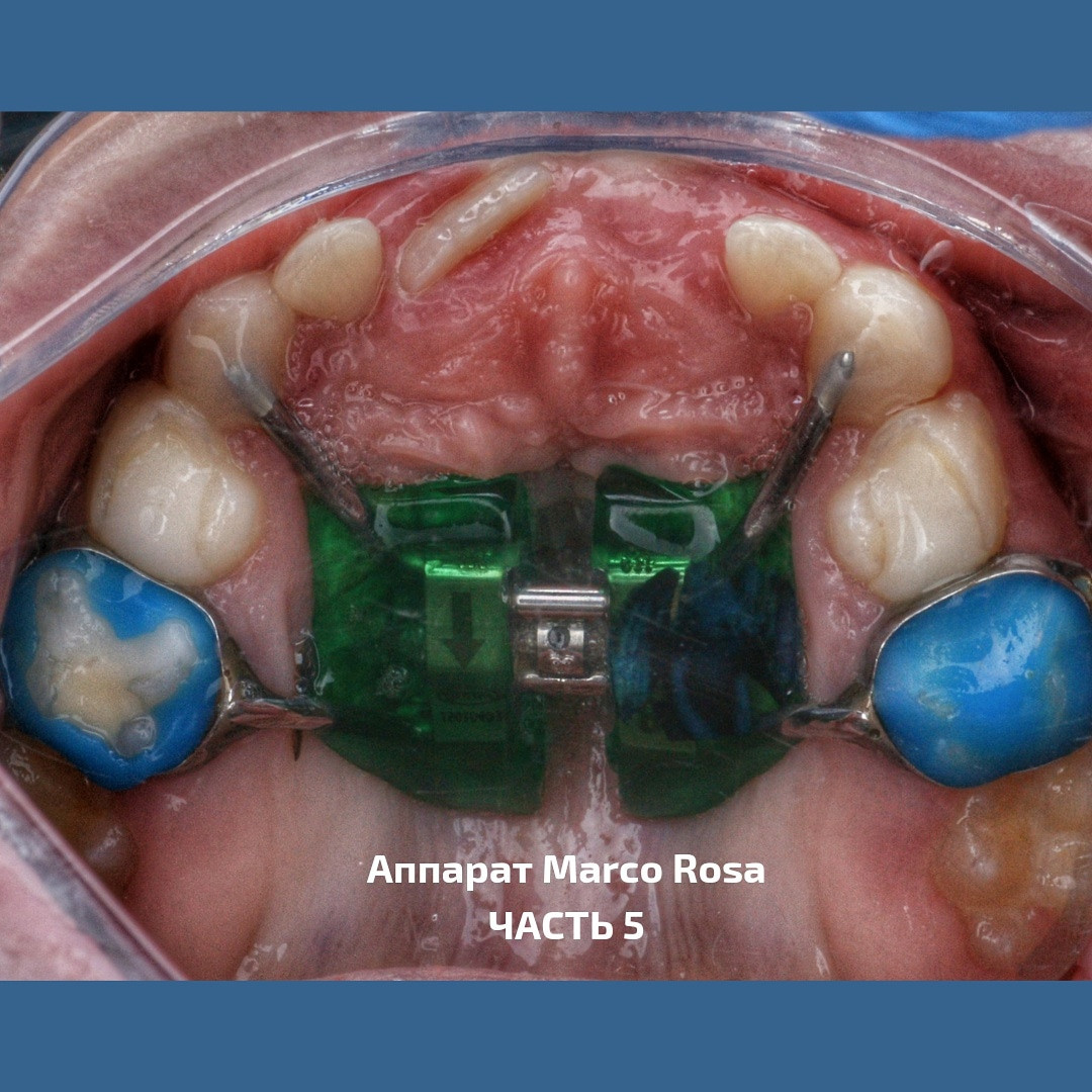 Блог врача. Стоматология «Ортодонт-Эстетик». Установка брекетов в Оренбурге, взрос