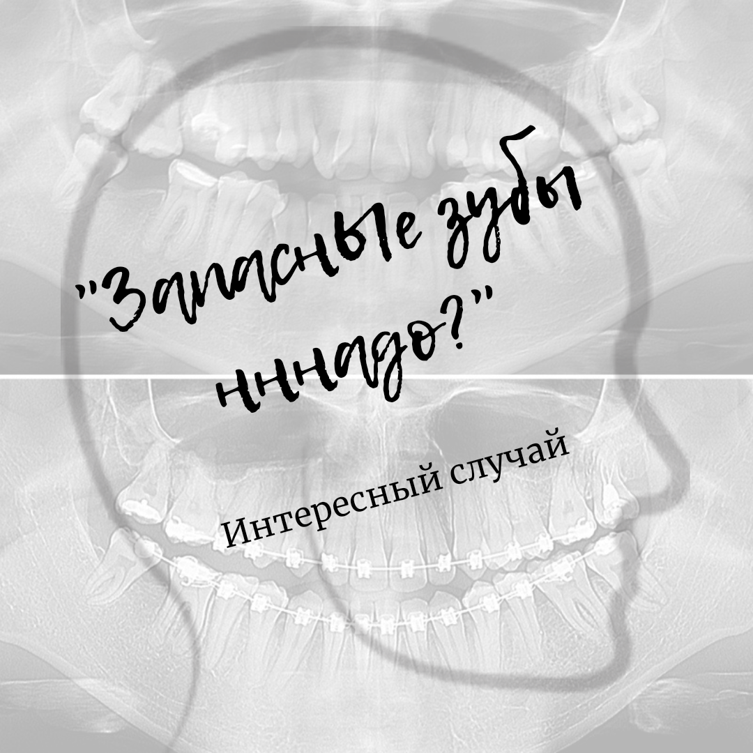 Блог врача. Стоматология «Ортодонт-Эстетик». Установка брекетов в Оренбурге, взрос