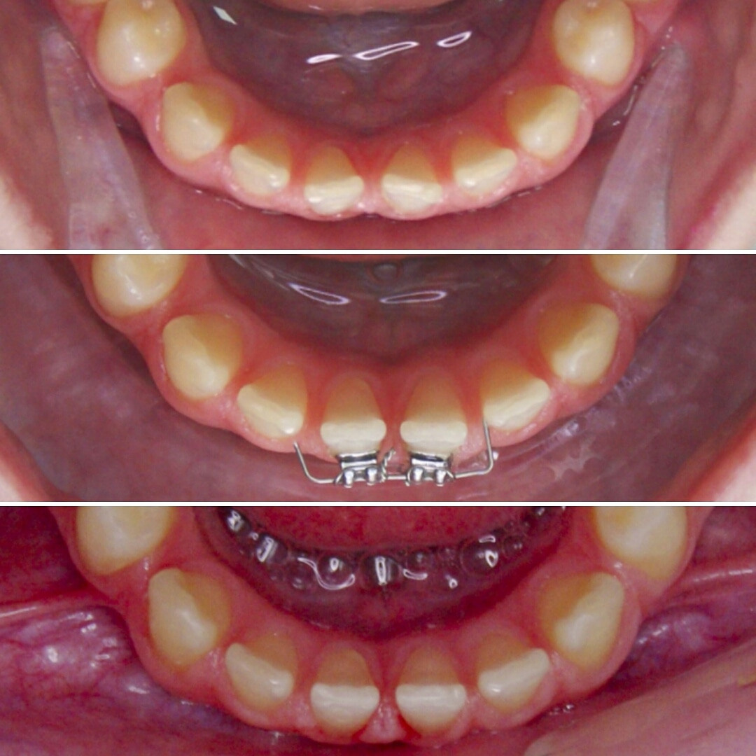Блог врача. Стоматология «Ортодонт-Эстетик». Установка брекетов в Оренбурге, взрос
