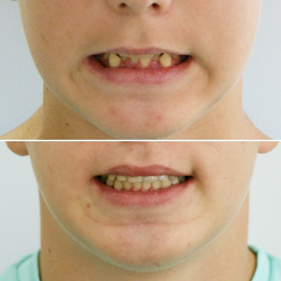 Блог врача. Стоматология «Ортодонт-Эстетик». Установка брекетов в Оренбурге, взрос