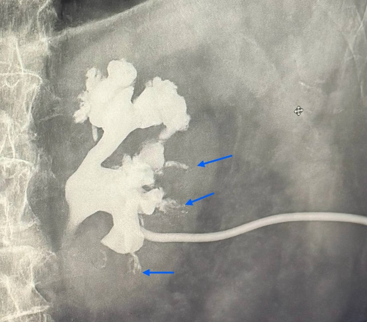 ЛОХАНОЧНО-ПОЧЕЧНЫЙ РЕФЛЮКС. РЕНТГЕН КТ МРТ в Санкт-Петербурге Александра Лоншакова
