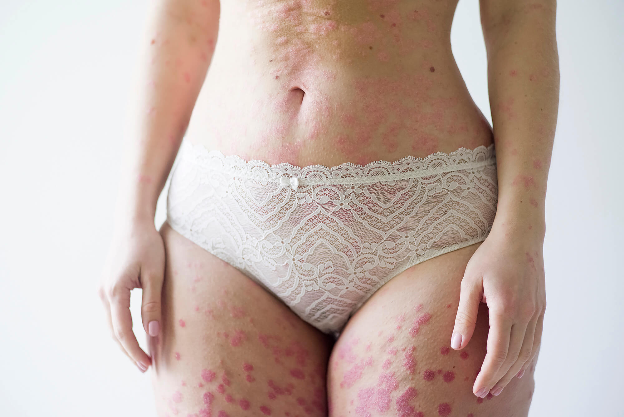 портрет женского тела в псориаз