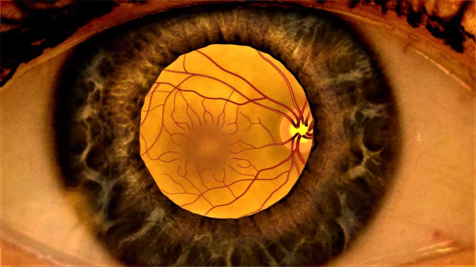 Результат по макулодистрофии (макулярной дегенерации). «Сово-Сова» продукция для омоложения, здоровья и долголетия