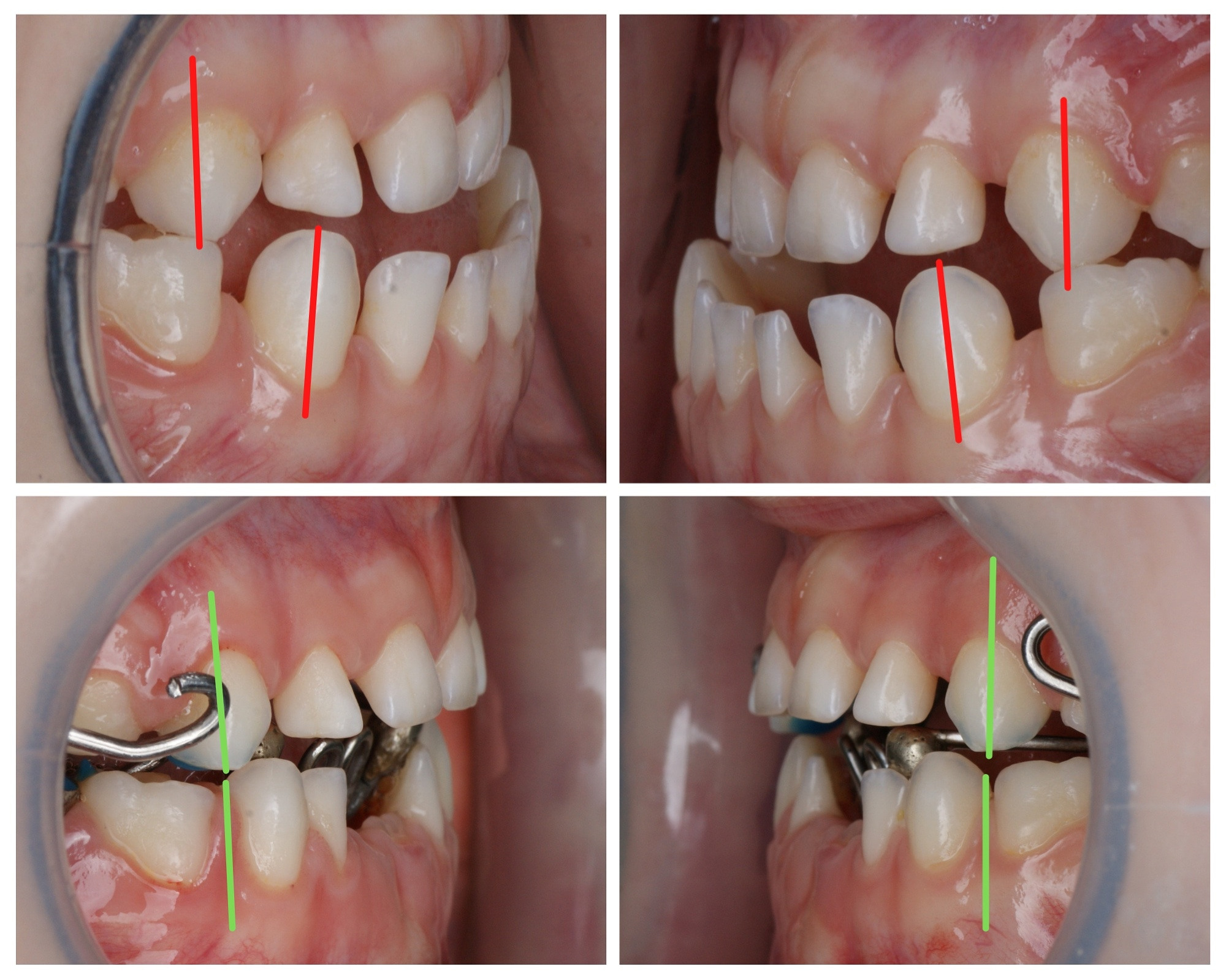 Блог врача. Стоматология «Ортодонт-Эстетик». Установка брекетов в Оренбурге, взрос