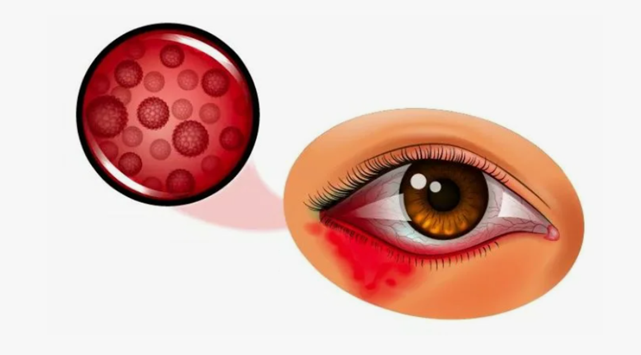 Вирусные инфекции глаз - какие препараты компании Сово-Сова помогут
