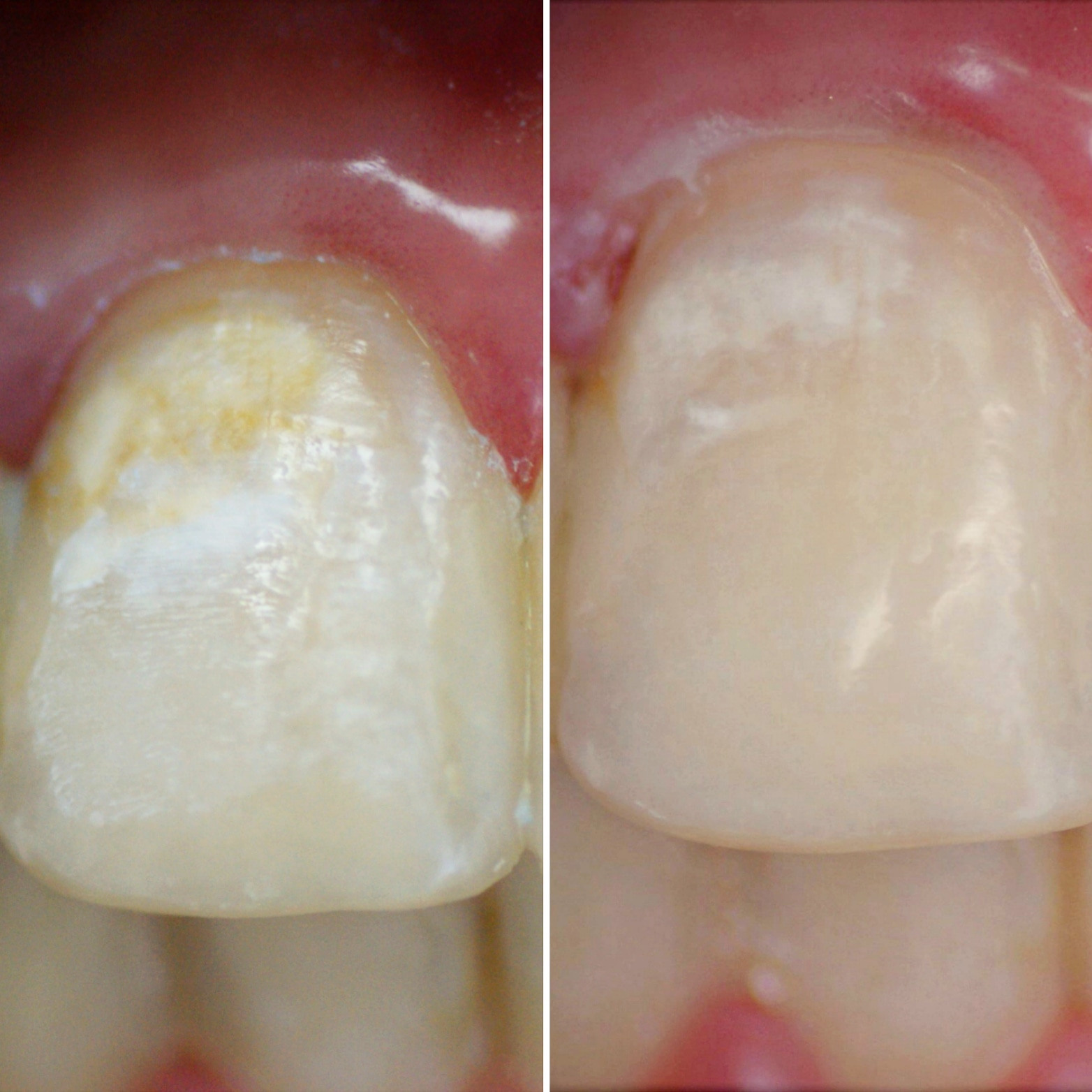 Блог врача. Стоматология «Ортодонт-Эстетик». Установка брекетов в Оренбурге, взрос