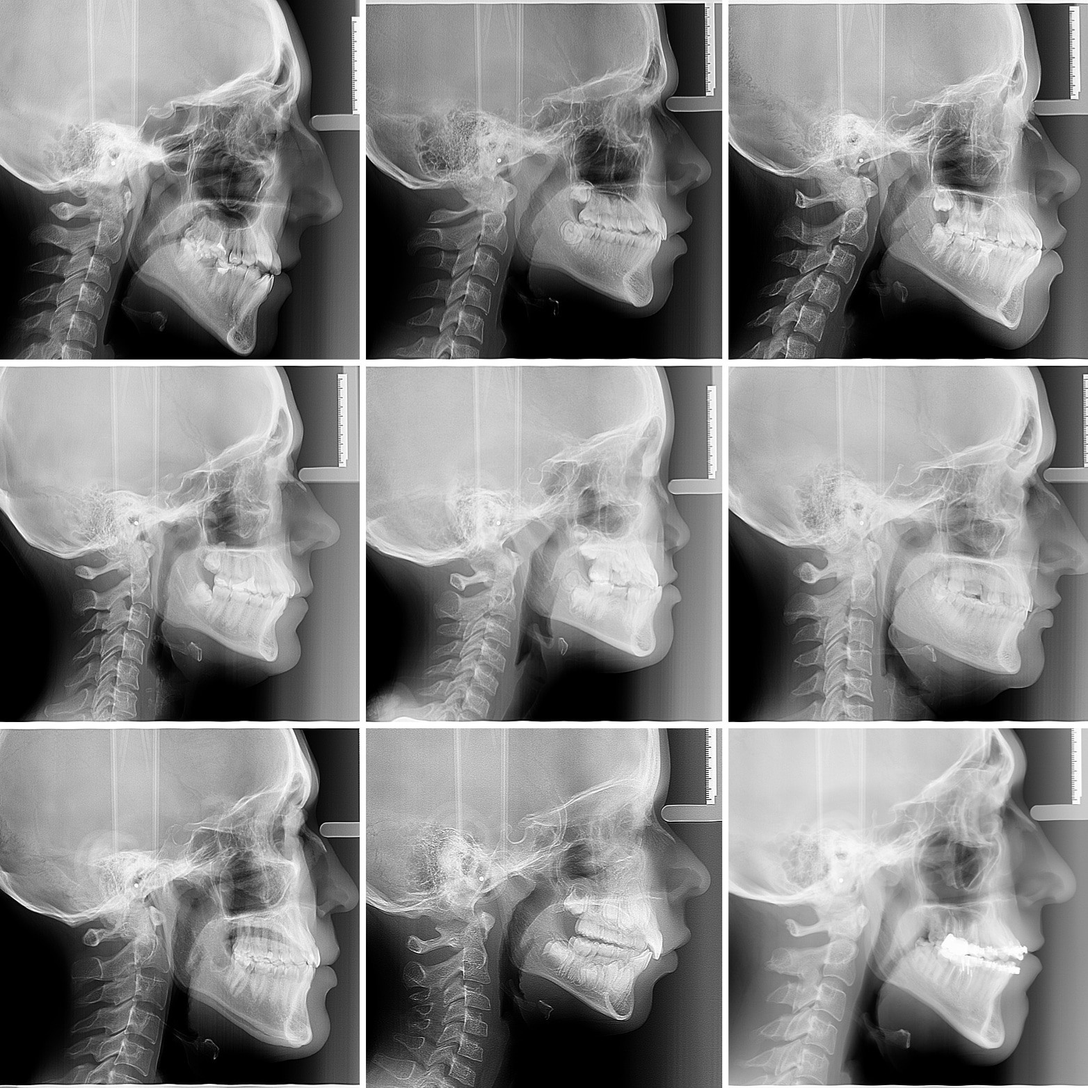 Блог врача. Стоматология «Ортодонт-Эстетик». Установка брекетов в Оренбурге, взрос