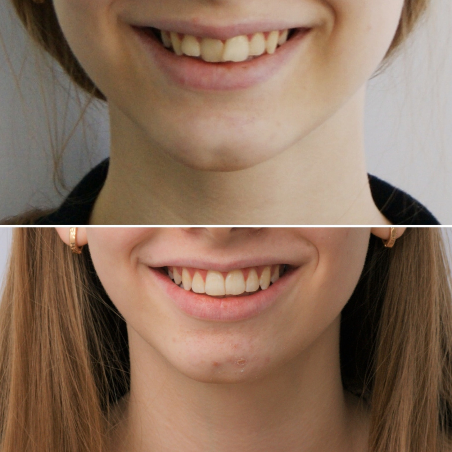 Блог врача. Стоматология «Ортодонт-Эстетик». Установка брекетов в Оренбурге, взрос