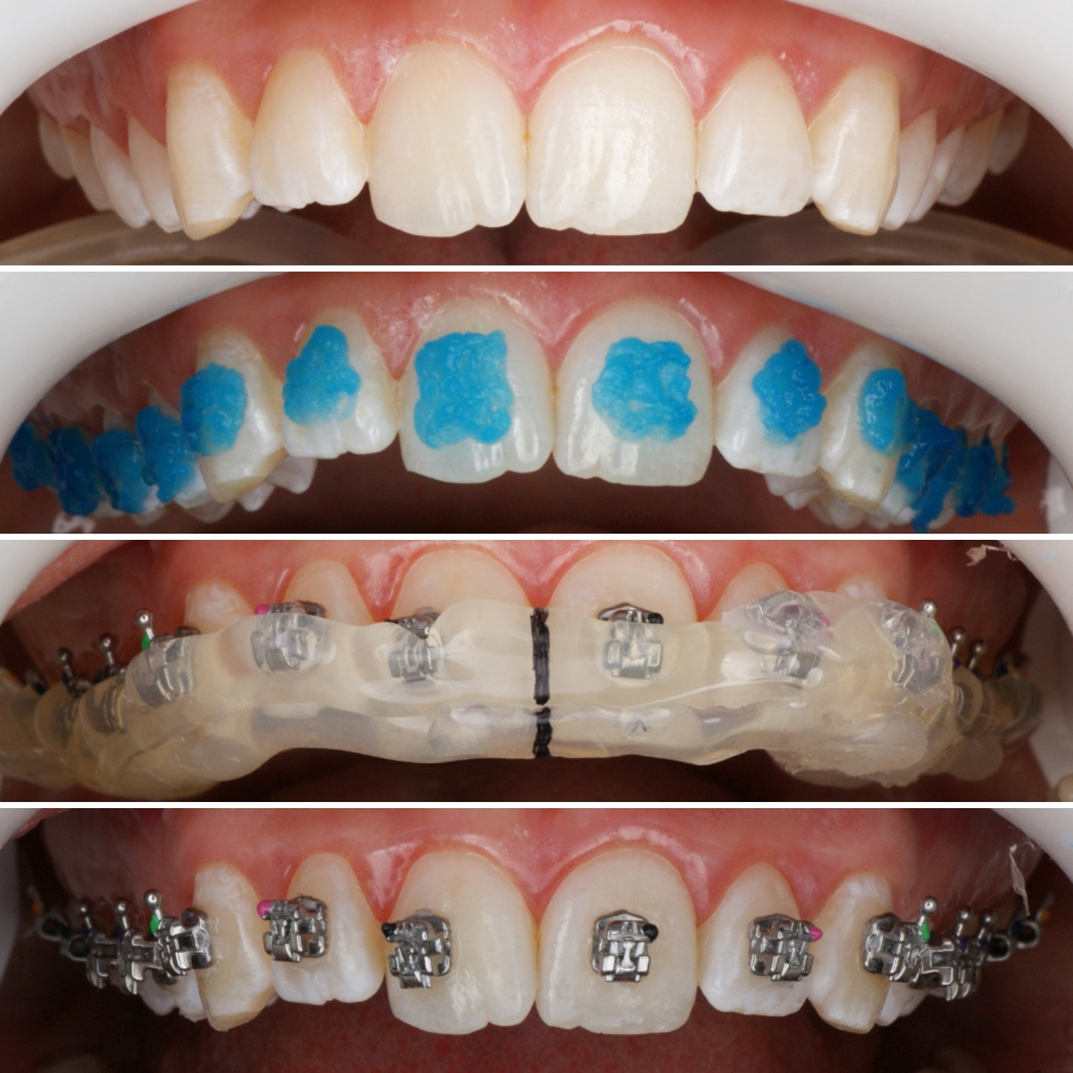 Блог врача. Стоматология «Ортодонт-Эстетик». Установка брекетов в Оренбурге, взрос