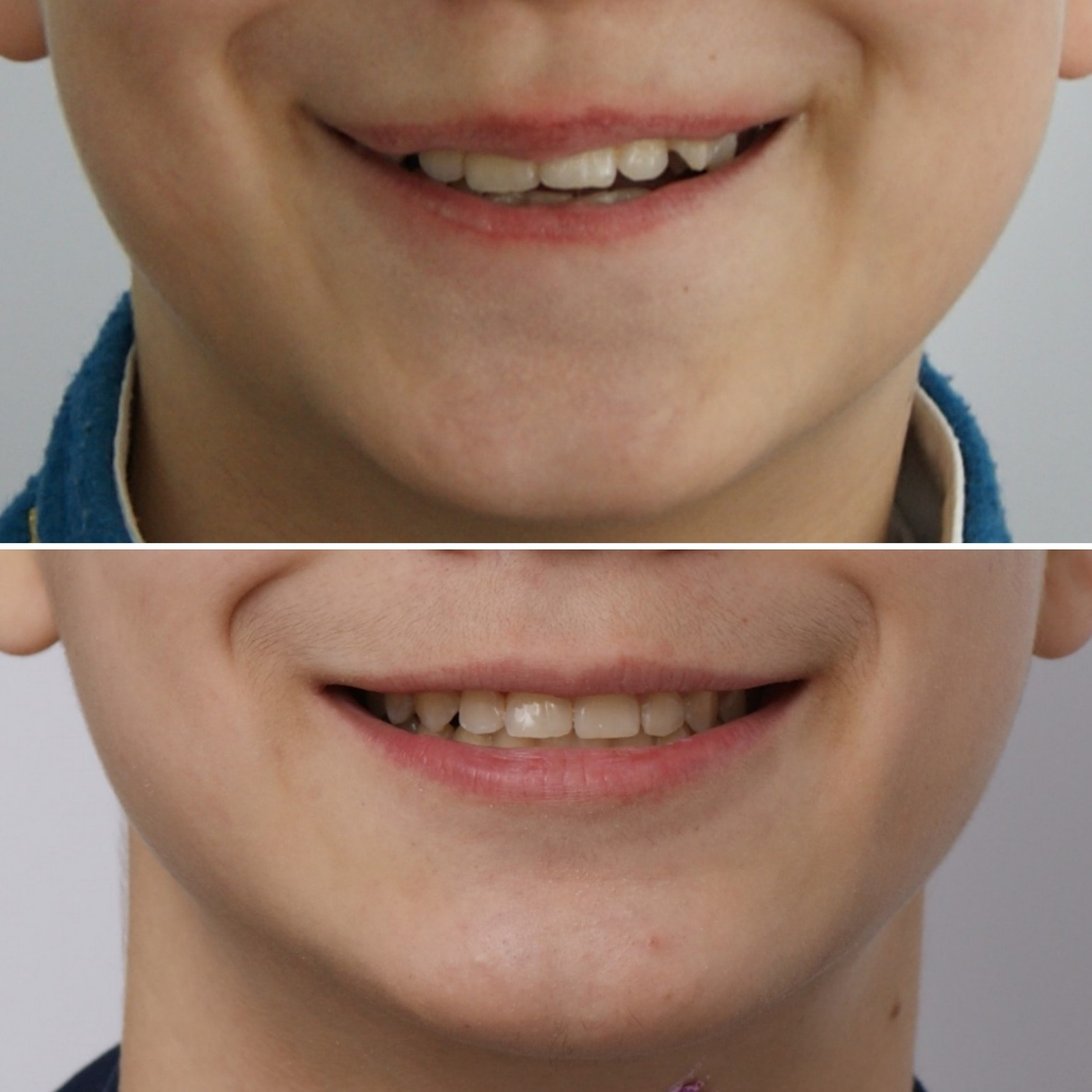 Блог врача. Стоматология «Ортодонт-Эстетик». Установка брекетов в Оренбурге, взрос