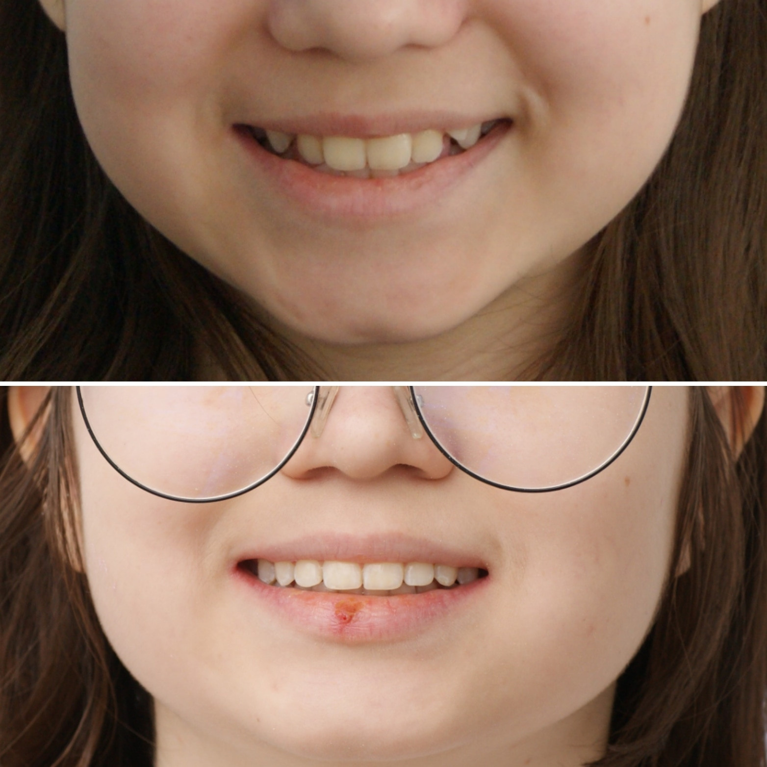 Блог врача. Стоматология «Ортодонт-Эстетик». Установка брекетов в Оренбурге, взрос