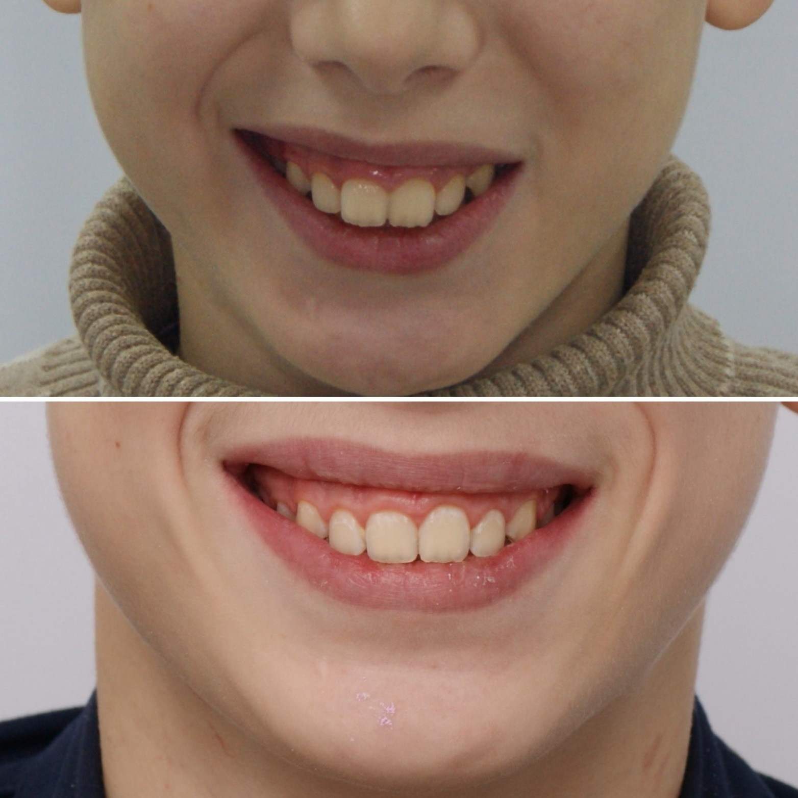 Блог врача. Стоматология «Ортодонт-Эстетик». Установка брекетов в Оренбурге, взрос